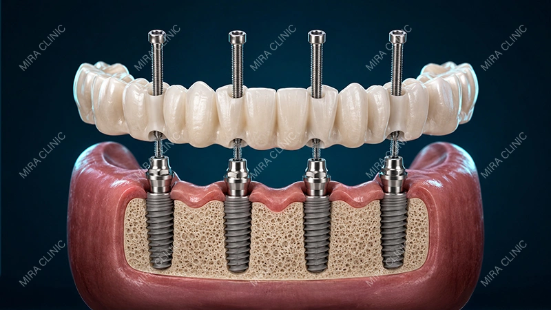 Implant Bridge Attached With Screws
